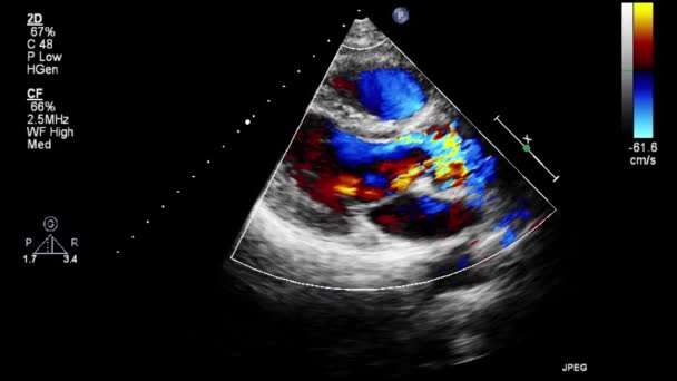 Hoge Kwaliteit Video Echografie Transslokdarmonderzoek Van Het Hart — Stockvideo