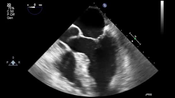 高质量的电视超声食管检查心脏 — 图库视频影像