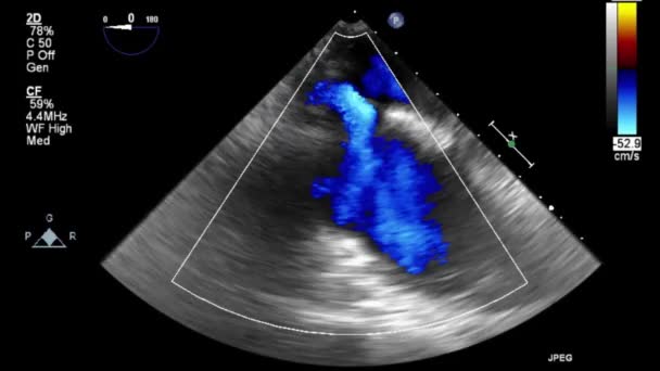 Hoge Kwaliteit Video Echografie Transslokdarmonderzoek Van Het Hart — Stockvideo