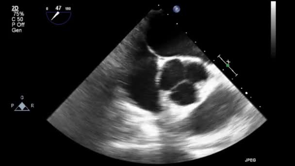 Hoge Kwaliteit Video Echografie Transslokdarmonderzoek Van Het Hart — Stockvideo