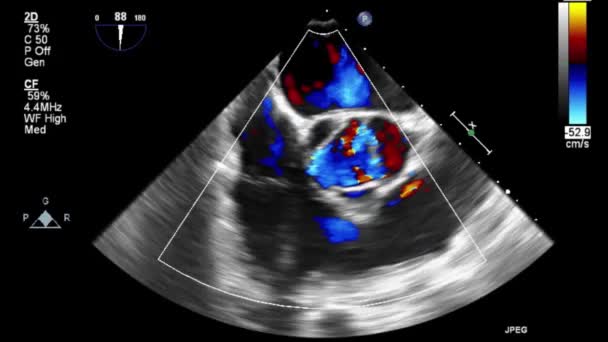 Hoge Kwaliteit Video Echografie Transslokdarmonderzoek Van Het Hart — Stockvideo