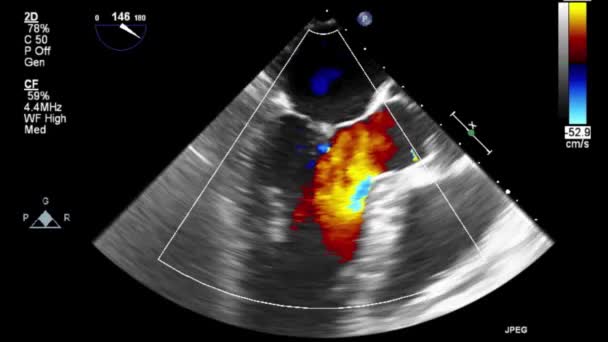 Hoge Kwaliteit Video Echografie Transslokdarmonderzoek Van Het Hart — Stockvideo