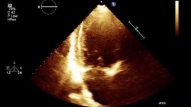 Kalbin yüksek kaliteli ultrason transsofageal muayenesi..