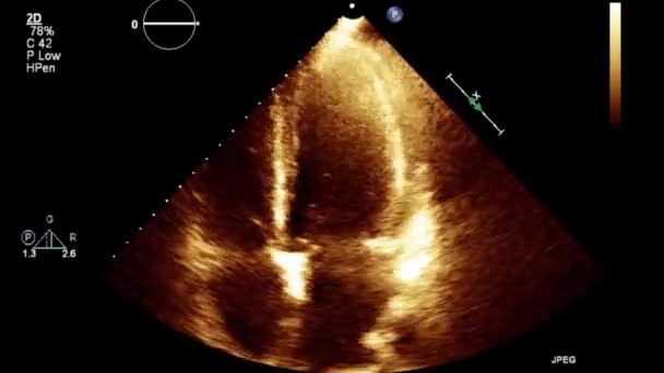 Laadukas Video Ultraääni Transesofageaalinen Tutkimus Sydämen — kuvapankkivideo
