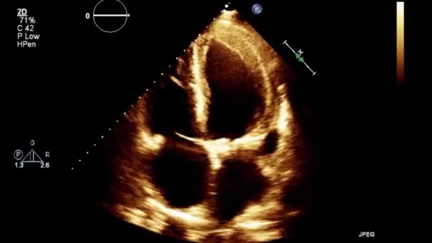 Качественное Видео Ультразвуковое Трансофагеальное Обследование Сердца — стоковое видео