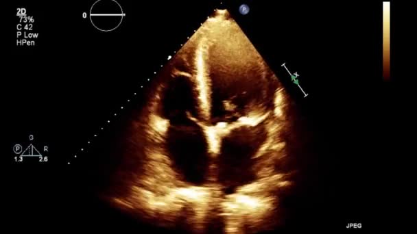Laadukas Video Ultraääni Transesofageaalinen Tutkimus Sydämen — kuvapankkivideo