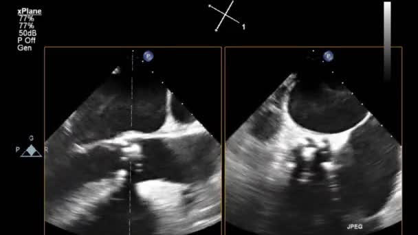 Examen Transesofágico Por Ultrasonido Video Alta Calidad Del Corazón — Vídeos de Stock