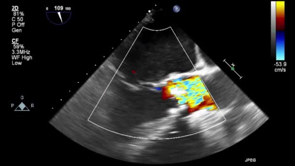 Hoge Kwaliteit Video Echografie Transslokdarmonderzoek Van Het Hart — Stockvideo