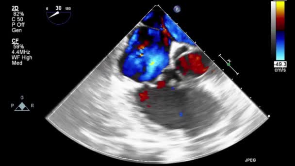 Examen Transesofágico Por Ultrasonido Video Alta Calidad Del Corazón — Vídeo de stock