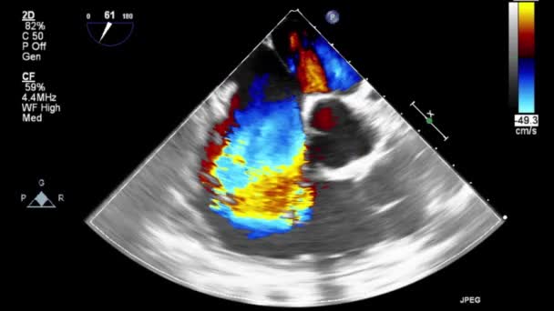 Examen Transesofágico Por Ultrasonido Video Alta Calidad Del Corazón — Vídeo de stock