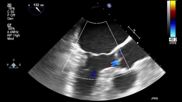 Vysoce Kvalitní Video Ultrazvukové Transesofageální Vyšetření Srdce — Stock video