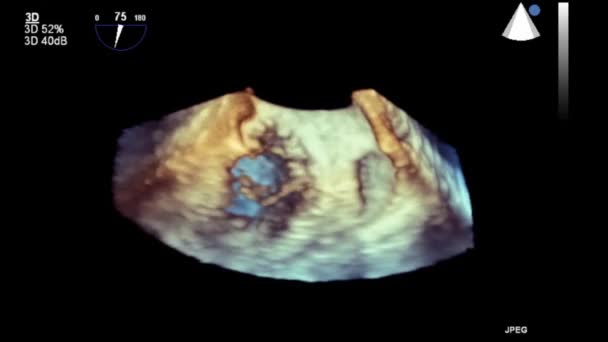 Hoge Kwaliteit Video Echografie Transslokdarmonderzoek Van Het Hart — Stockvideo