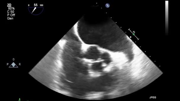 Examen Transesofágico Por Ultrasonido Video Alta Calidad Del Corazón — Vídeo de stock