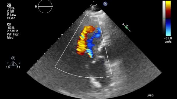 Hoge Kwaliteit Video Echografie Transslokdarmonderzoek Van Het Hart — Stockvideo