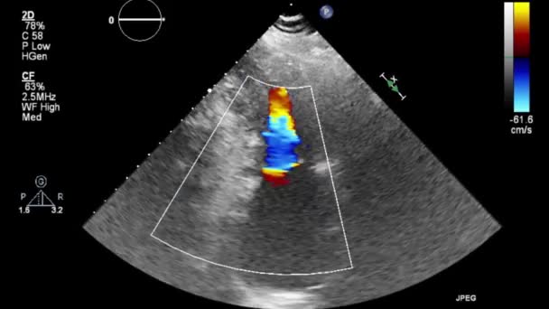 Hochwertige Video Ultraschall Transesophagealuntersuchung Des Herzens — Stockvideo