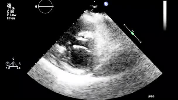 高质量的电视超声食管检查心脏 — 图库视频影像