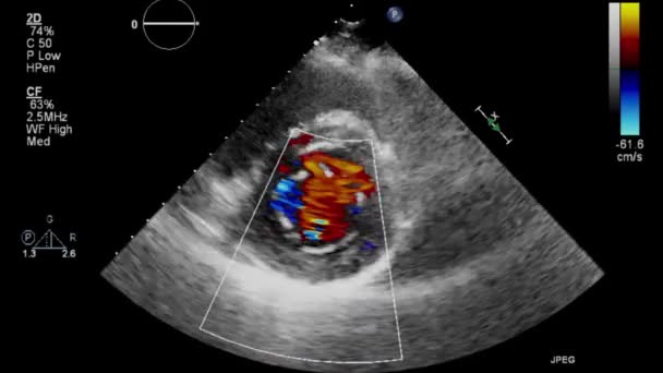 Examen Transesofágico Por Ultrasonido Video Alta Calidad Del Corazón — Vídeos de Stock