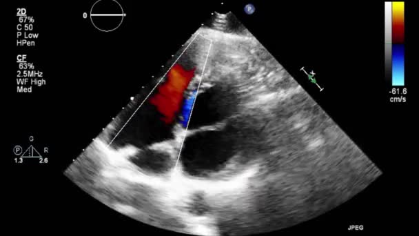 Hoge Kwaliteit Video Echografie Transslokdarmonderzoek Van Het Hart — Stockvideo