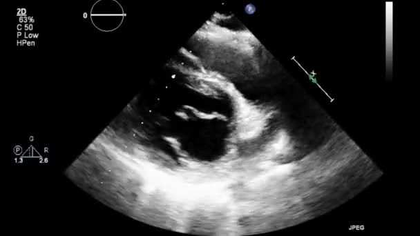 Examen Transesofágico Por Ultrasonido Video Alta Calidad Del Corazón — Vídeos de Stock