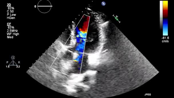 Hochwertige Video Ultraschall Transesophagealuntersuchung Des Herzens — Stockvideo