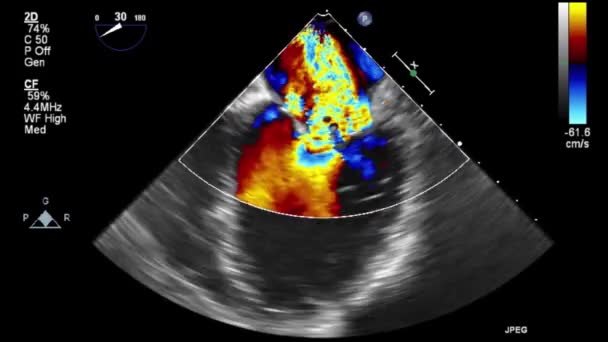 Examen Transesofágico Por Ultrasonido Video Alta Calidad Del Corazón — Vídeo de stock