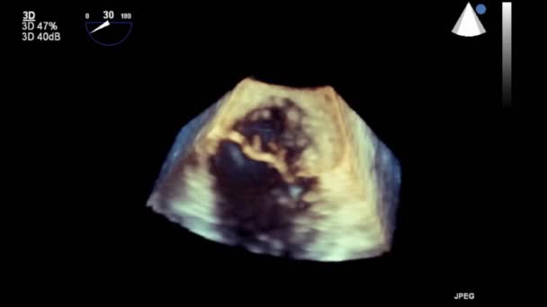 Hoge Kwaliteit Video Echografie Transslokdarmonderzoek Van Het Hart — Stockvideo