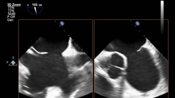 Vídeo Ultra Som Alta Qualidade Exame Transesofágico Coração — Vídeo de Stock