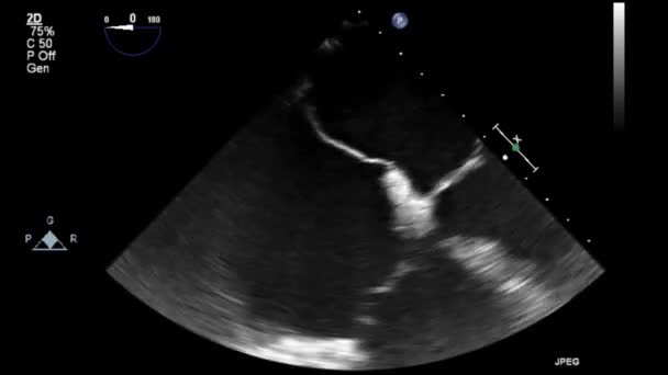 Wysokiej Jakości Wideo Usg Przełyku Badanie Serca — Wideo stockowe