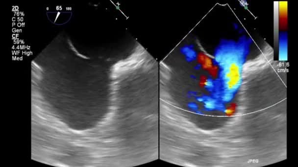 Hoge Kwaliteit Video Echografie Transslokdarmonderzoek Van Het Hart — Stockvideo