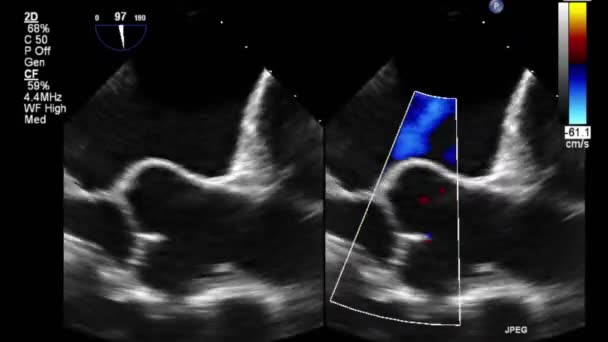 Hoge Kwaliteit Video Echografie Transslokdarmonderzoek Van Het Hart — Stockvideo