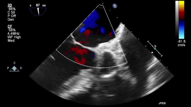 Kalbin Yüksek Kaliteli Ultrason Transsofageal Muayenesi — Stok video