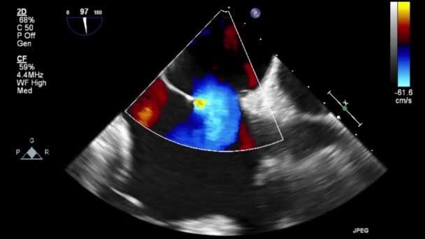 High Quality Video Ultrasound Transesophageal Examination Heart — Stock Video