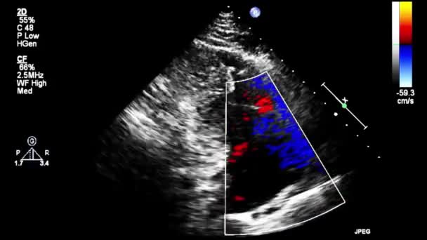 Ecografia Video Alta Qualità Esame Transesofageo Del Cuore — Video Stock