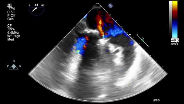 Échographie Vidéo Haute Qualité Examen Transœsophagien Cœur — Video