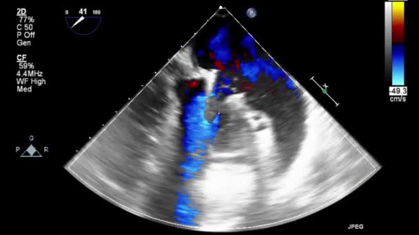 Vysoce Kvalitní Video Ultrazvukové Transesofageální Vyšetření Srdce — Stock video