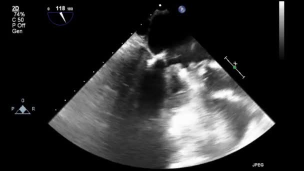 Hoge Kwaliteit Video Echografie Transslokdarmonderzoek Van Het Hart — Stockvideo