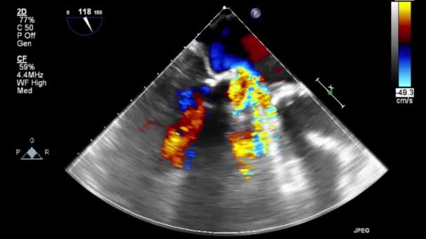 Examinarea Transesofagiană Video Înaltă Calitate Inimii — Videoclip de stoc