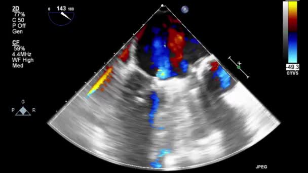 Vysoce Kvalitní Video Ultrazvukové Transesofageální Vyšetření Srdce — Stock video
