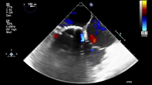 Examen Transesofágico Por Ultrasonido Video Alta Calidad Del Corazón — Vídeo de stock