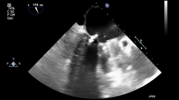 Hoge Kwaliteit Video Echografie Transslokdarmonderzoek Van Het Hart — Stockvideo