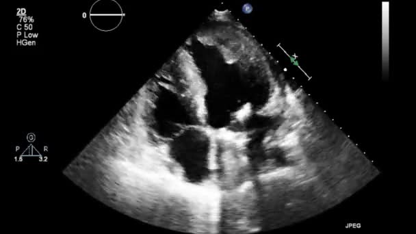 Examen Transesofágico Por Ultrasonido Video Alta Calidad Del Corazón — Vídeo de stock