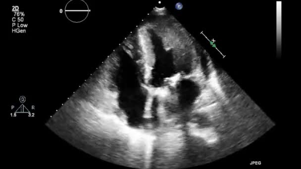 High Quality Video Ultrasound Transesophageal Examination Heart — Stock Video