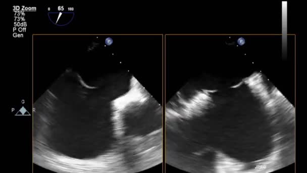 Échographie Vidéo Haute Qualité Examen Transœsophagien Cœur — Video