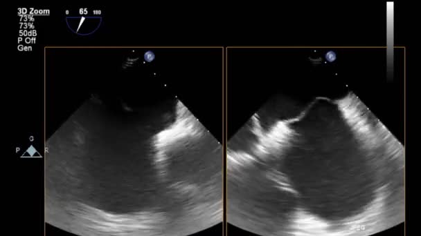 Échographie Vidéo Haute Qualité Examen Transœsophagien Cœur — Video