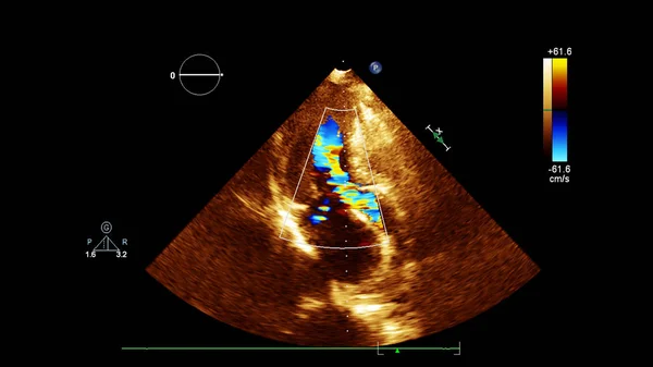 Bild Hjärtat Transesofagalt Ultraljud Med Dopplerläge — Stockfoto