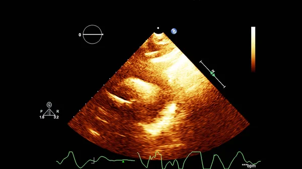 Image Heart Gray Scale Mode Transesophageal Ultrasound — Stock Photo, Image