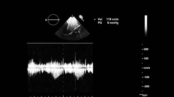 Obrázek Srdce Šedém Měřítku Během Transesofageálního Ultrazvuku — Stock fotografie