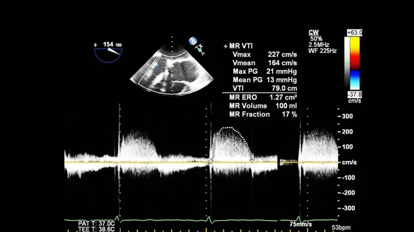 Imagem Coração Durante Ultrassom Transesofágico Com Modo Doppler — Fotografia de Stock