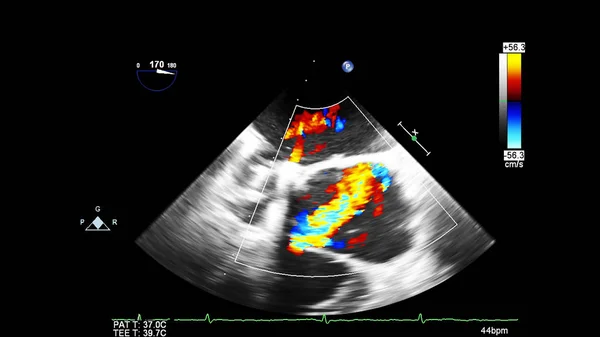 Изображение Сердца Время Трансофагеального Ультразвука Доплеровским Режимом — стоковое фото