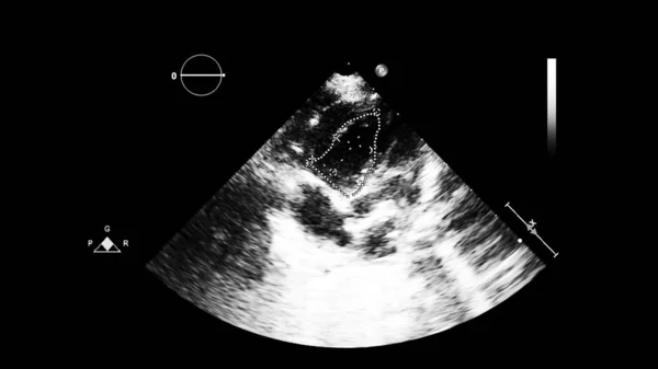 Afbeelding Van Het Hart Grijs Schaal Modus Tijdens Transesofageale Echografie — Stockfoto